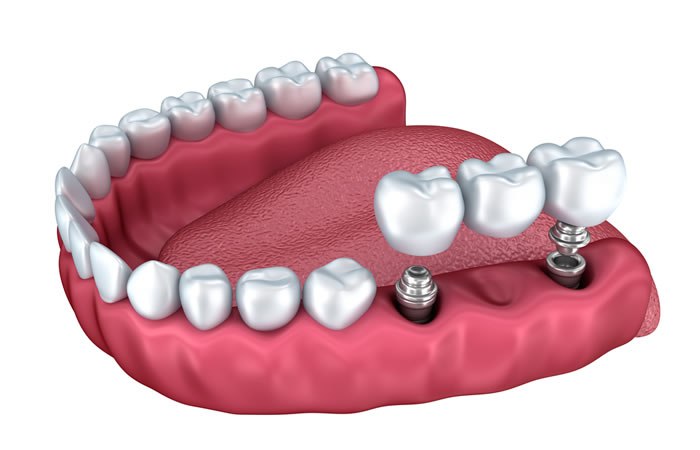 protesis-sobre-implantes-dentales-barcelona.jpg