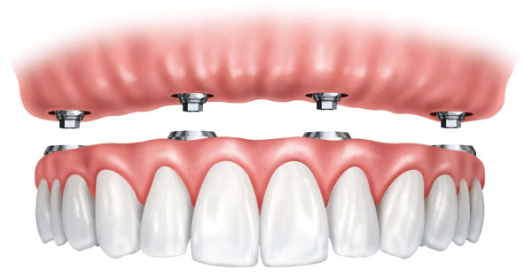 xdentadura_fija_4_implantes_precio.jpg.pagespeed.ic_.0k-mwQdNO9.jpg